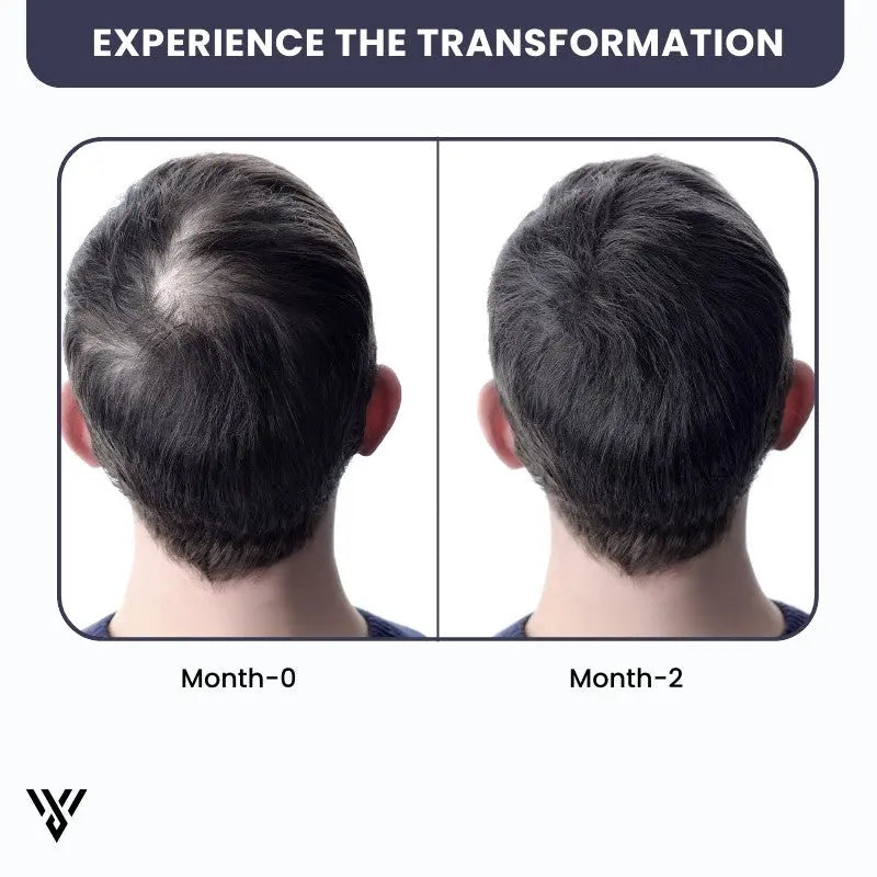 100% Pure Unrefined Batana Hair Oil (120ml, 1-bottle pack), showing a 2-month transformation from falling hair to growing hair - VAYOME.