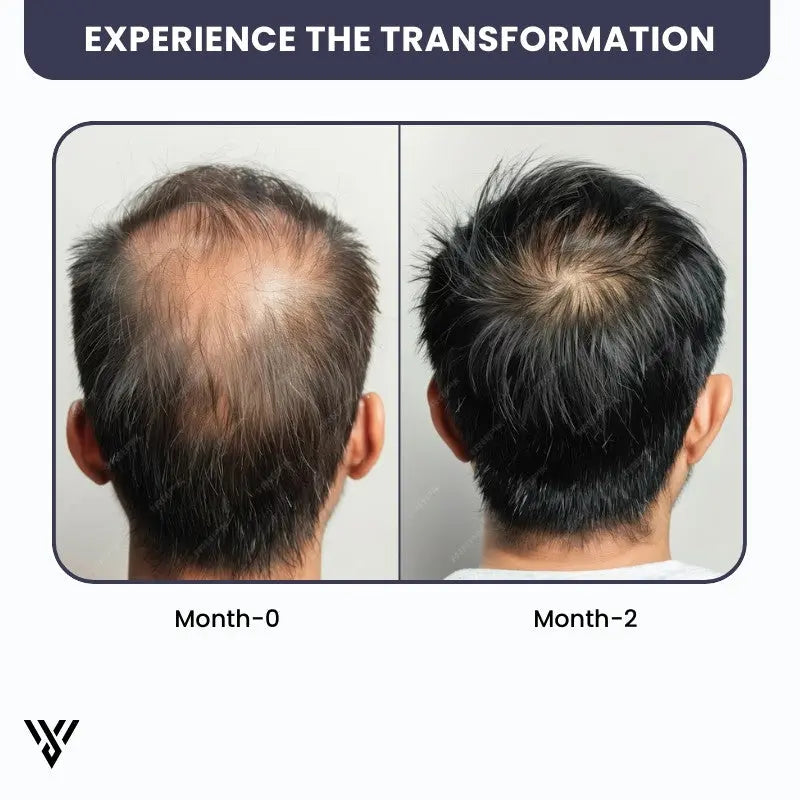 100% Pure Unrefined Batana Hair Oil (120ml, 1-bottle pack), showing a 2-month transformation from falling hair to growing hair - VAYOME.