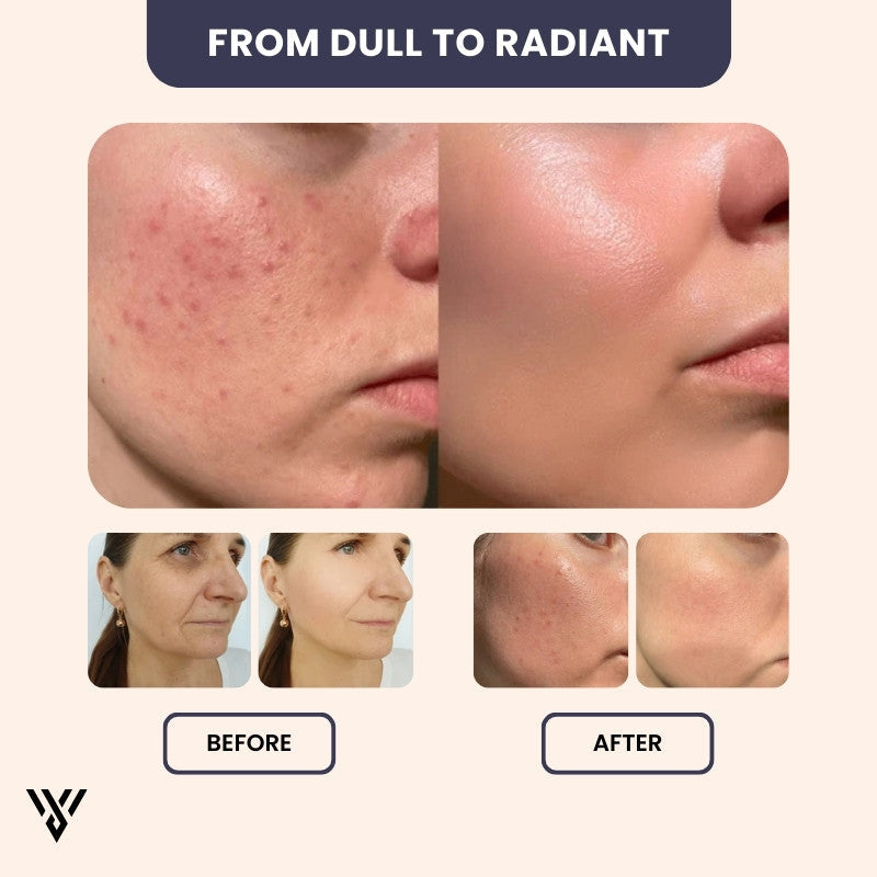 Hyaluronic Acid Serum (15ML), anti-aging and hydrating, before/after image showing transformation from dull to radiant skin - VAYOME.