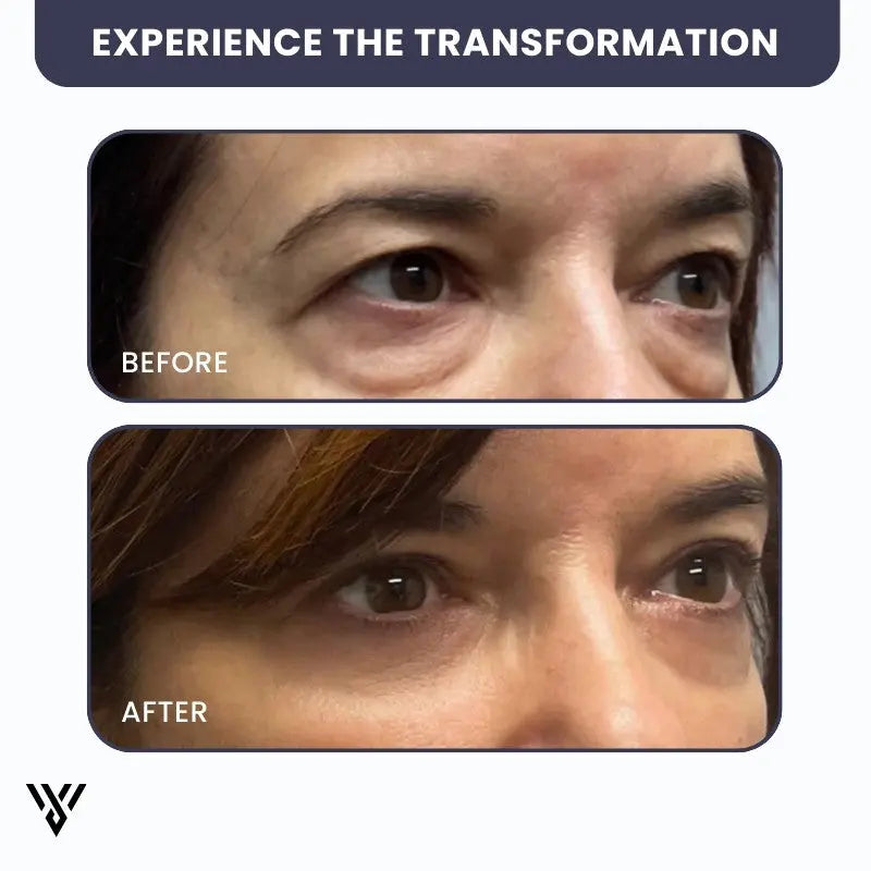 Hydrogel Eye Patch Pro in Gold color, which diminishes puffiness and under-eye bags, prompting the user to experience the transformation - VAYOME.